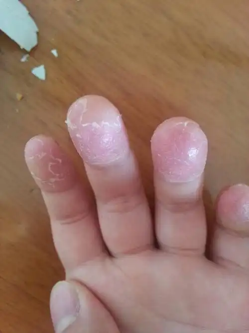 小孩子手脱皮是怎么回事