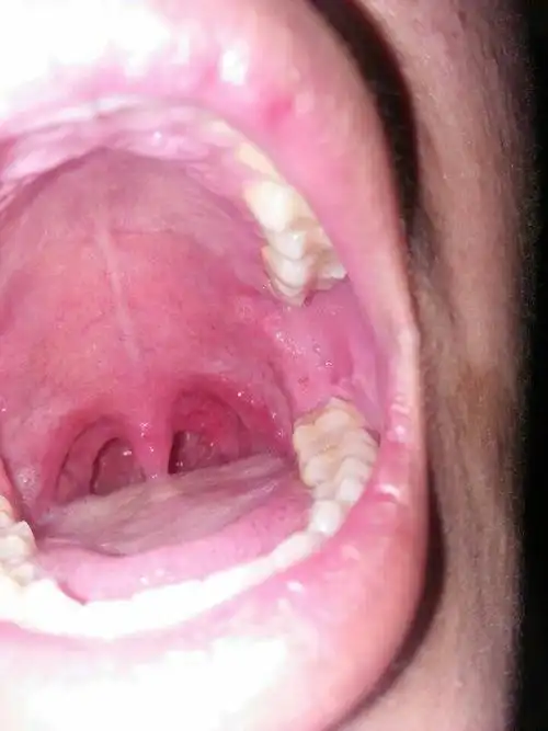 张开嘴一会左彻扁桃体窝感觉很干,看着扁桃体窝内那一小块肉要变白似