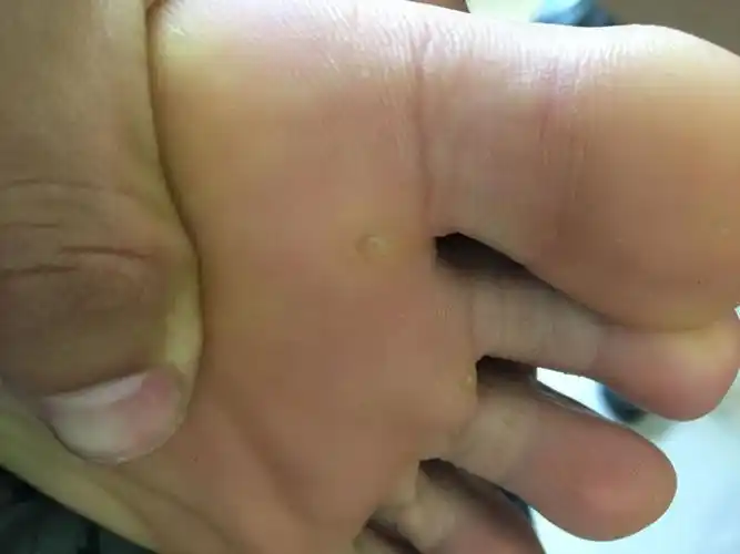 鸡眼图片初期症状 鸡眼早期症状图片