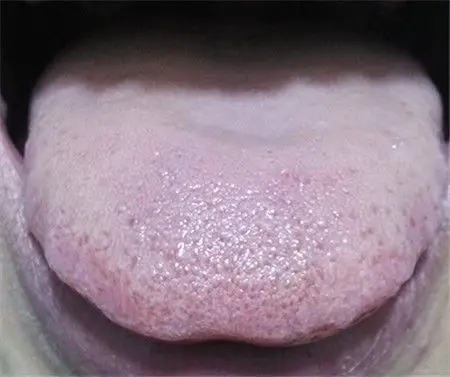 舌苔发白是怎么回事