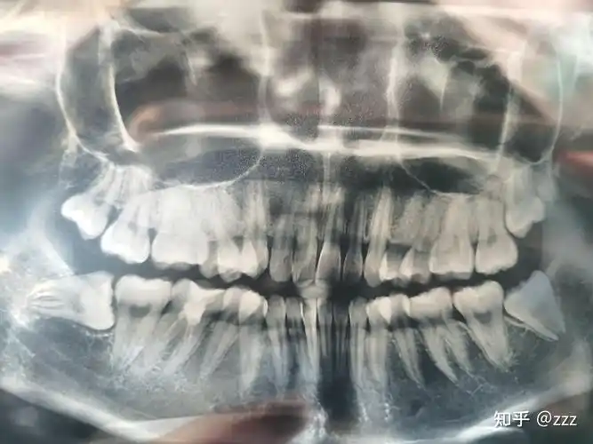 中大附属口腔医院拔横长的阻生智齿