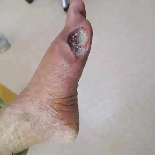 糖尿病足溃疡的及时清创是糖尿病足避免截肢以及伤口愈合的基础.