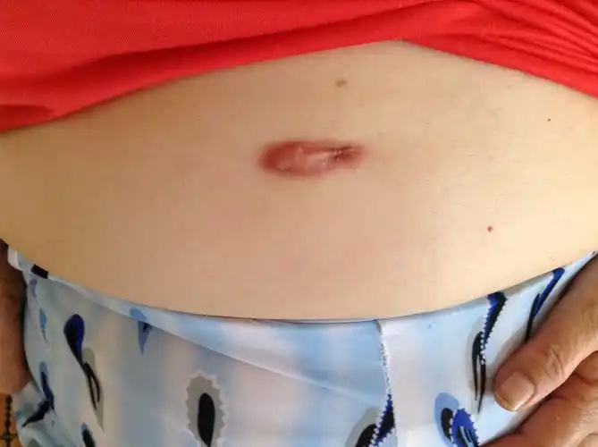 做胆结石手术一年半了,刀口鼓了一个蚕豆大的包,请问怎么办?