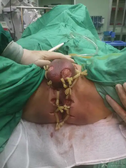 一例肛周坏死性筋膜炎切口愈合全过程