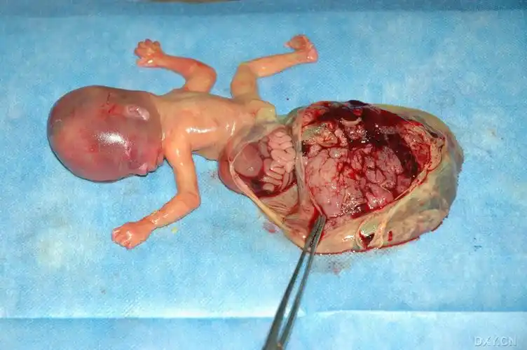 【请教】急:胎儿畸形的图片,该下什么诊断?