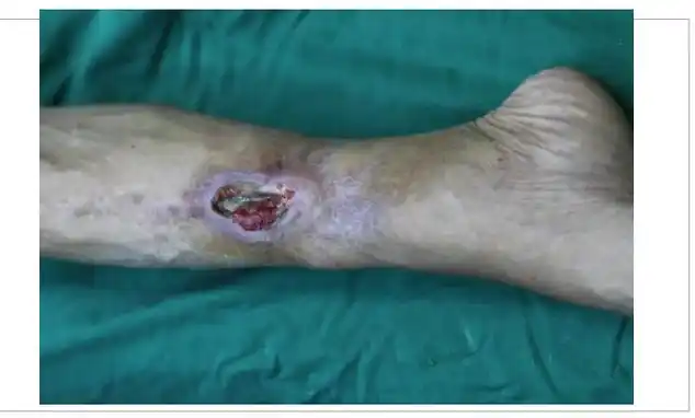 创面修复骨髓炎患者痊愈出院78岁老人腿部反复溃烂久治不愈只因7岁