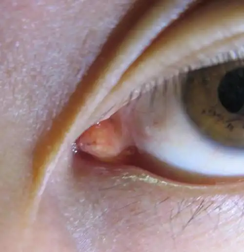 右眼内眼角有个白色的疙瘩,有一两个月了才发现,不痛不痒.