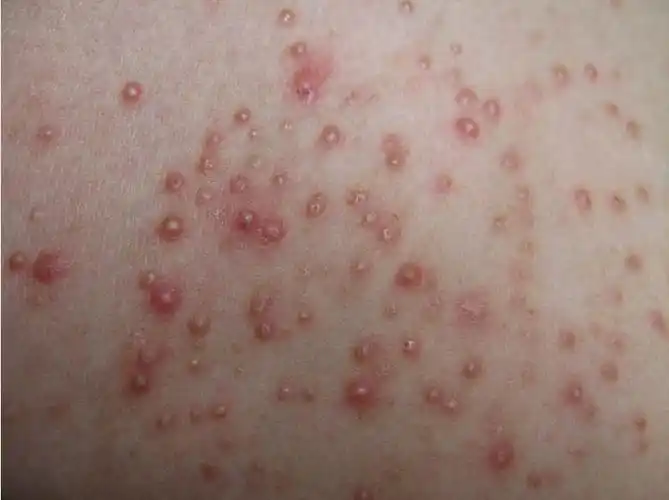 毛囊炎都有哪些常见的类型