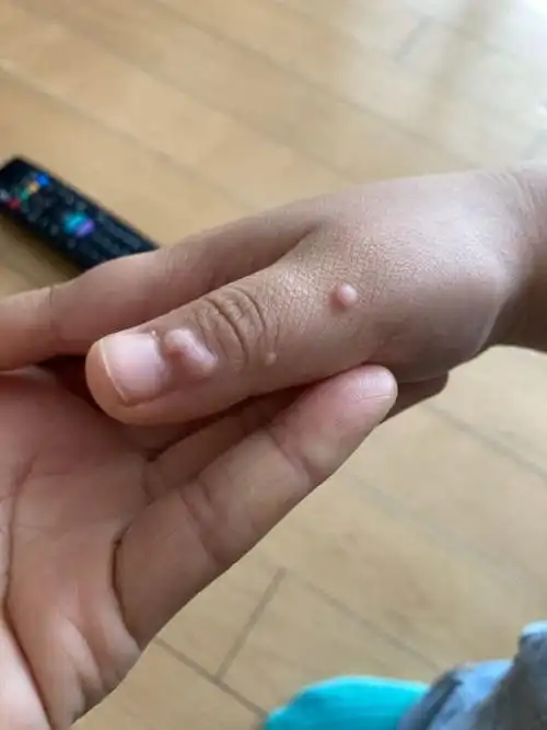 所以如果孩子长了手瘊子或者软疣,先别着急,给孩子慢慢调理,慢慢会好