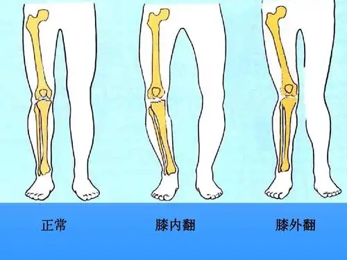 正常 膝内翻 膝外翻