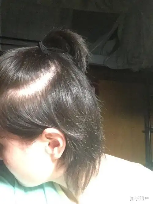 女生头顶头发少是什么体验