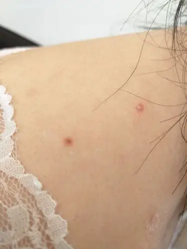 我想问一下,这两个可以说是同一时间长得,这是蜱虫咬的,还是正常粉刺?