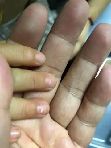 儿童的指甲上有白色的块块,朋友说是缺锌了,我看着像被什么夹了一下