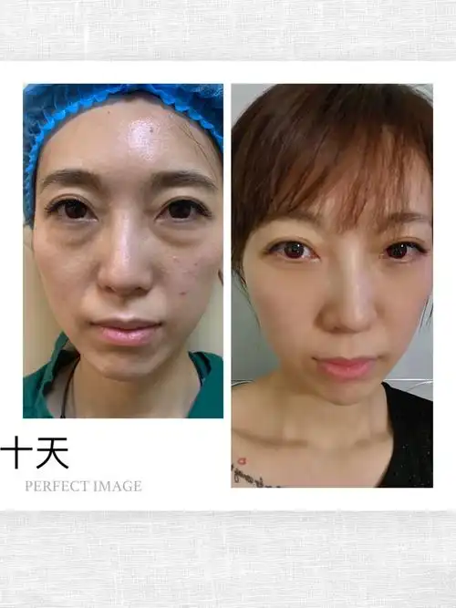 做去眼袋手术第十天啦,眼睛也是到了一个稳定期也是不_圈子-新氧美容