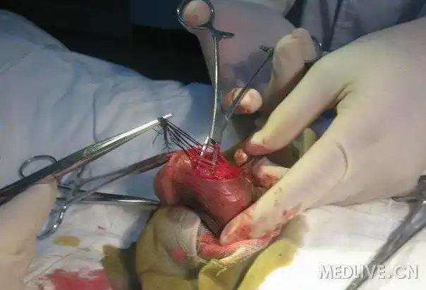 图阴茎背神经离断术手术