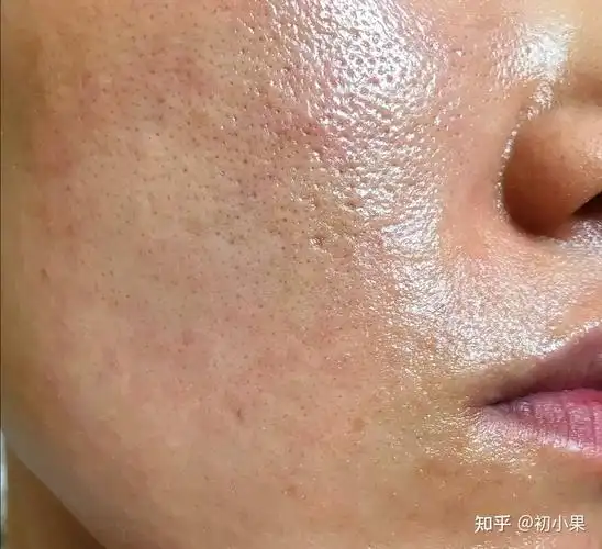 如何真正减少脸部油脂的过多分泌? - 知乎