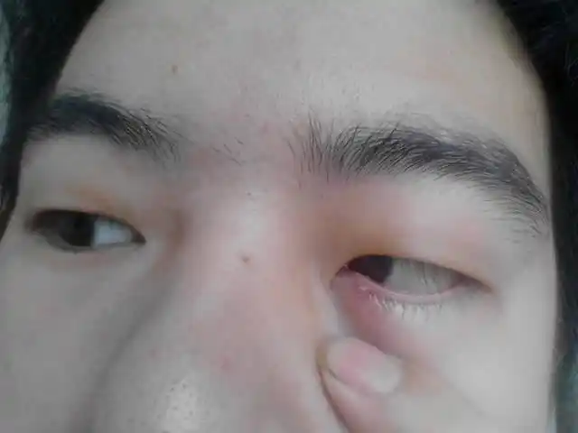 刚开始去药店人家说是麦粒肿,拿了眼药水一个星期不到就好了,过了几个