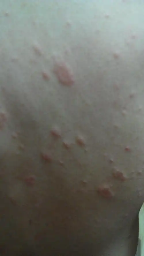 背后突然长了些小包痒,不知道是什么?有图