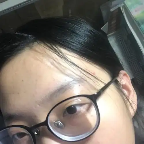 的背景 不是先天性,爸妈近视只有三四百度 小学二年级近视,应该是假性