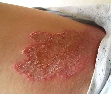 体癣初期图片 (6)