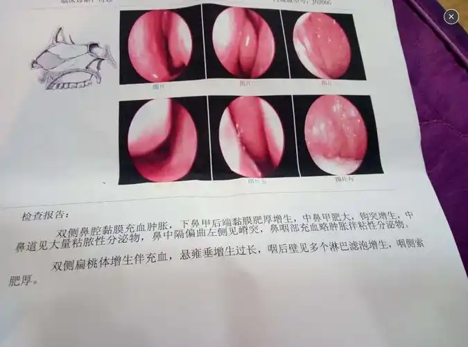 的种类不同,鼻炎症状也有所不同:(1)慢性鼻炎长期间歇性或交替性鼻塞