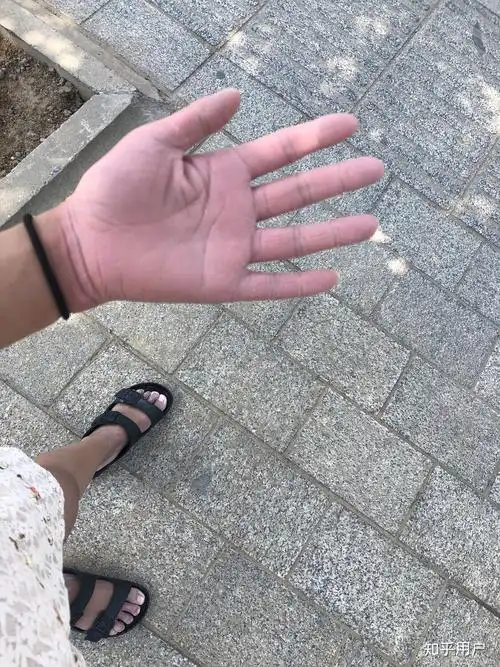 先天性就有掌跖角化症而且很严重有心理障碍