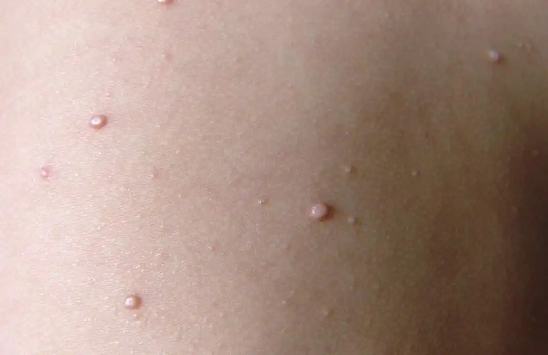 空姐感染hpv病毒,医生叹息,经常住酒店的人应该改掉两个习惯