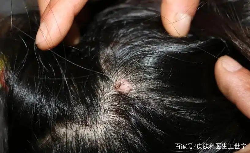 头皮上的这种纤维瘤需不需要切掉?