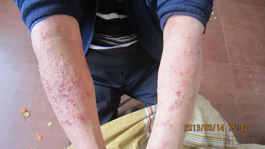 求助:神经性皮炎?湿疹?还是,,(超清图) - 全科医疗专业讨论版 - 爱爱