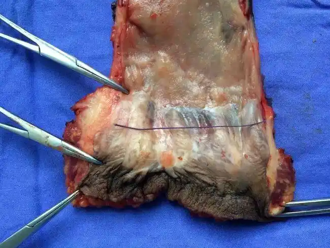 肛门有肿块可能是这8种疾病