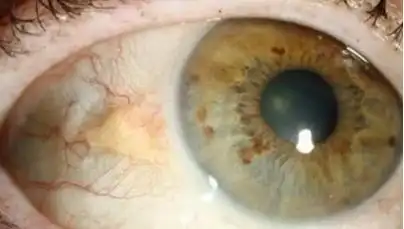 工作中常年面对电脑得了睑裂斑该怎么去除