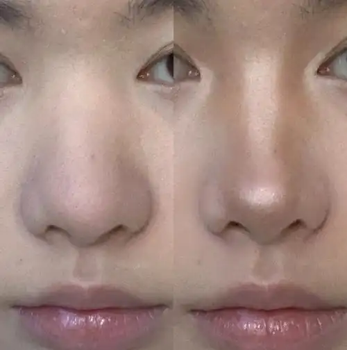 宽鼻骨圆鼻头79混血小盒鼻修容教程