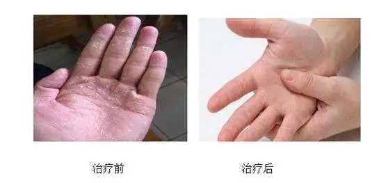 2个疗程后手癣症状消失,至今未出现复发情况. >>