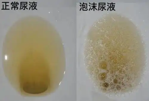 武汉名老中医王垚慢性肾炎蛋白尿2近2月小便混浊泡沫尿腰酸身困4年了