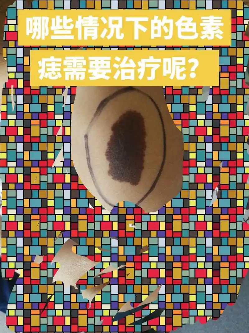 哪些情况下的色素痣需要治疗呢? - 抖音