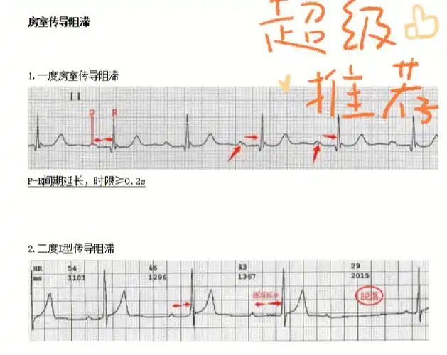 拿到一份心电图首先看心电图的基础节律,是否是窦性心律或房颤心律,先