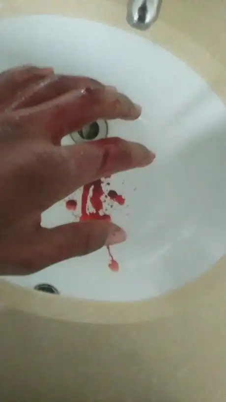 和别人打架手筋被切断了怎么办?一直在流血