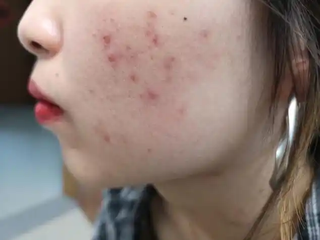 这是什么类型的痘痘?怎么根治? —— 从图片看可能是结节型痘痘.