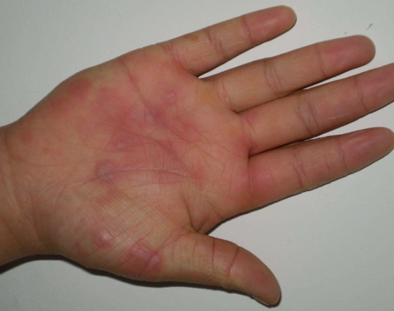 桃花藓症状图片 (1)_有来医生