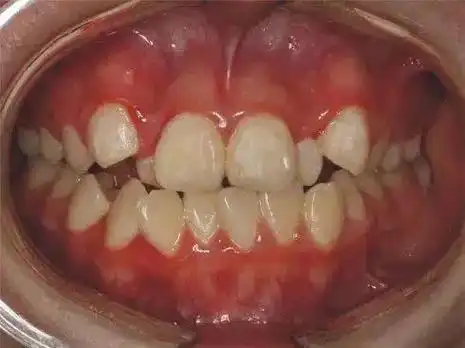 家长必看:孩子15岁前必须处理的11种畸形牙齿