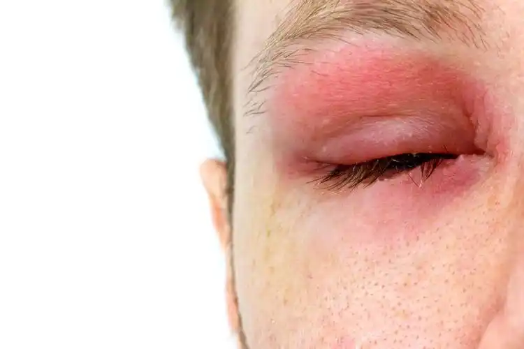 被虎头蜂蛰了的人图片