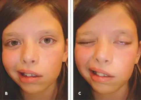 面瘫是怎么回事?哪些原因会引起面瘫