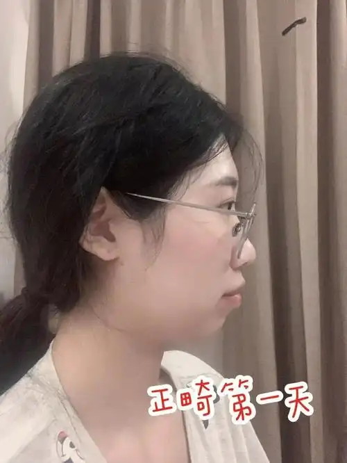 凸嘴女孩的矫正日记——正畸