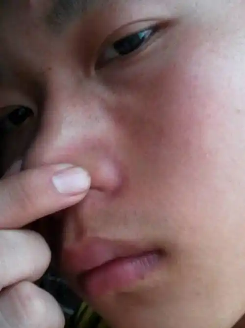 我鼻子原来好像长了粉刺,用手挤后就变的很红,一直不消而且还有粉刺