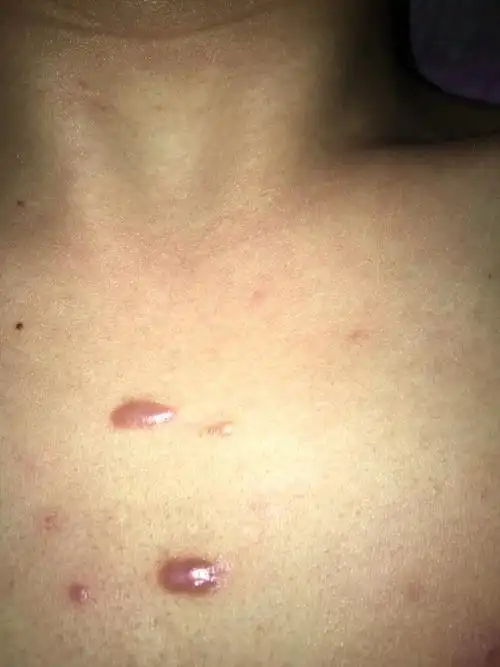 胸口前年长了两颗痘痘,因为挤得时候很疼,没把浓挤出来,所以到现在