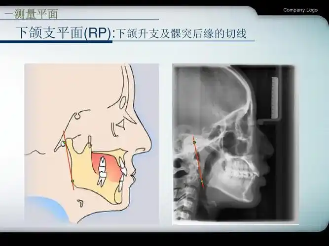 测量平面 company logo 下颌支平面(rp):下颌升支及髁突后缘的切线