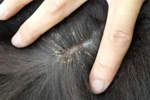 请问虱子卵长什么样子?能详细描述一下么?最好带图,谢谢!