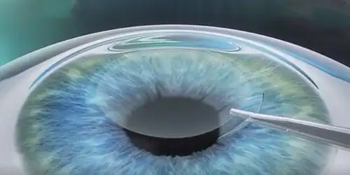 阳江全飞秒激光近视手术个人案例分享