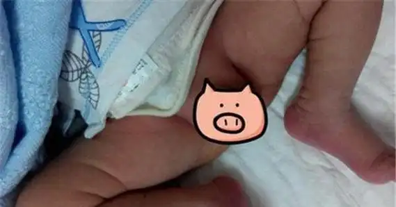 八个月宝宝的小鸡鸡没了,妈妈:这样细小的东西还真没注意到_网易订阅