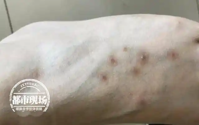 酒店住了3个月女子起了一身包她怀疑是床虱咬的